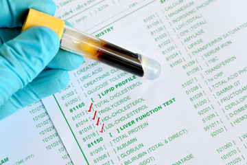 Blood sample for lipid profile testing