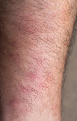 Red Sore Mosquito Bites on Leg