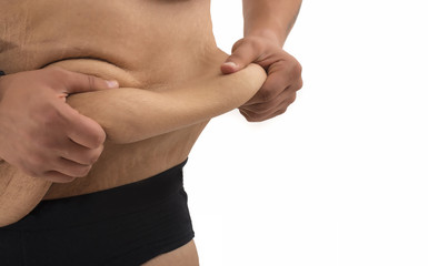 man with fat belly and stretch marks