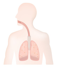 Lung Man Smoking