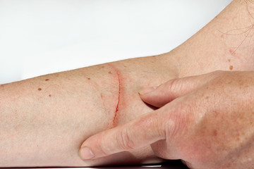 Fototapeta premium Eine blutende Verletzung am Arm einer Frau
