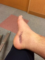 Internal bleeding