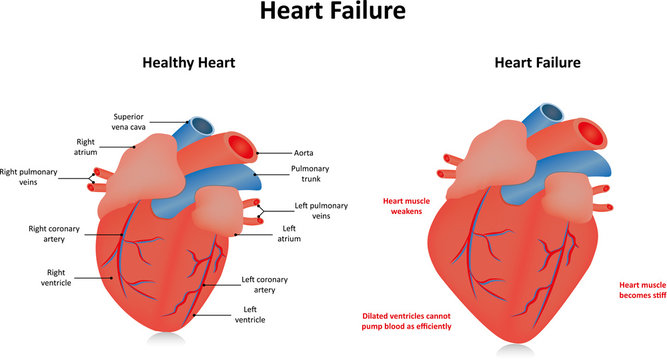 Heart Failure Labeled Diagram