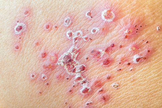 Herpes Zoster (Shingles) - After Treatment