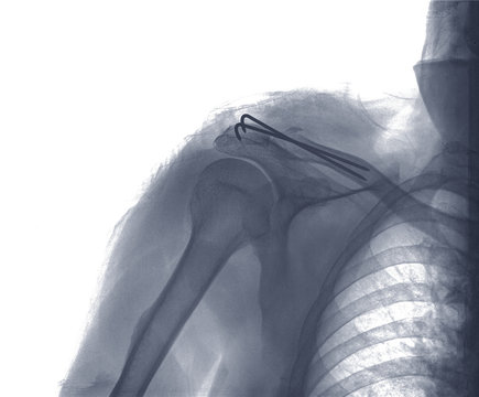 rengs snapshot of the shoulder joint with a bolt , xray