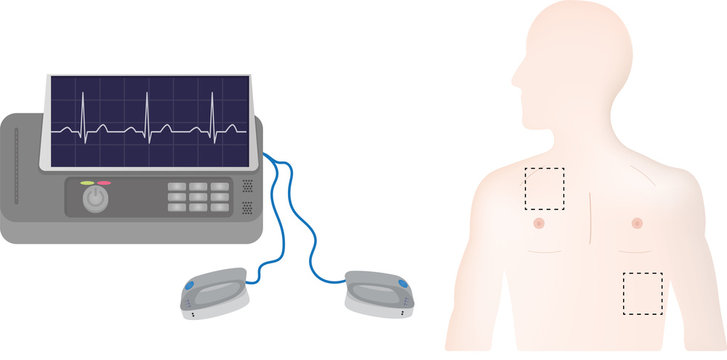 Defibrillator Positions