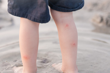 red itchy  bites on toddler boy's legs