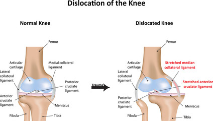 Dislocation of the Knee