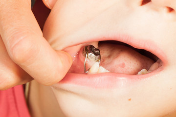 iron brace on the tooth child