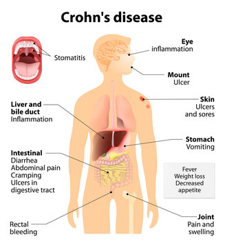 Crohn's disease or Crohn syndrome