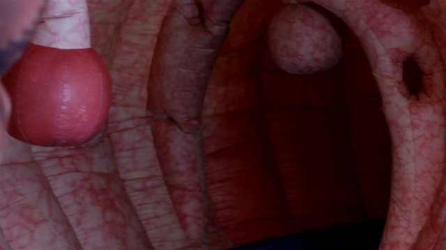 Inside of bowel disease - large example