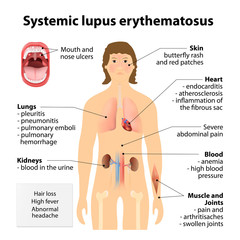 Systemic lupus erythematosu - obrazy, fototapety, plakaty