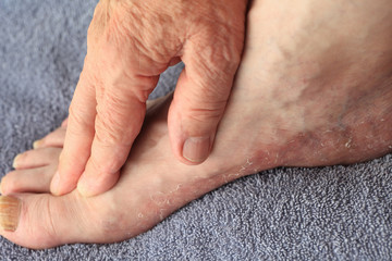 Foot with peeling skin of fungal infection