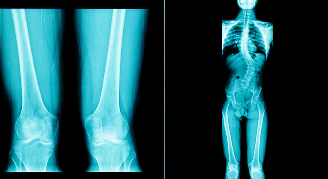 x-ray image of human have a long bone body