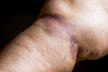 Fototapeta premium Closeup on a Bruise on wounded old woman leg skin