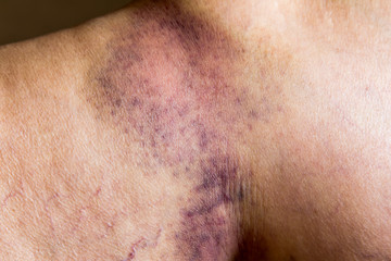 Fototapeta premium Closeup on a Bruise on wounded old woman leg skin