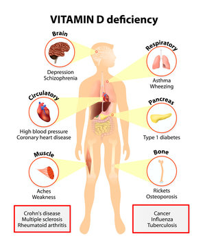 Vitamin D deficiency. symptoms and diseases