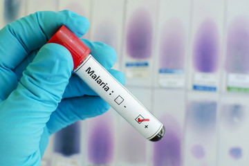 Fototapeta premium Malaria parasite positive