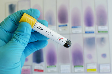 Hepatitis C virus (HCV) positive