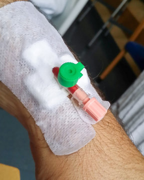 Infusionsnadel in einer Vene am Arm