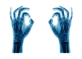 X-ray hand