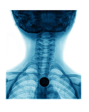 x-ray images of coin in esophagus