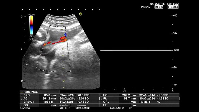 high quality ultrasound echography check. Gynecological medical examination. 33 weeks old pregnancy with fetus heartbeat recording and thermal analysis, high definition 1080p