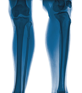 X-ray film of proximal tibia and intra articular fracture