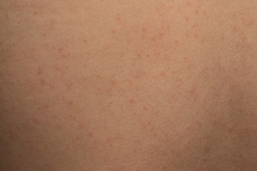 allergic rash dermatitis skin texture of patient