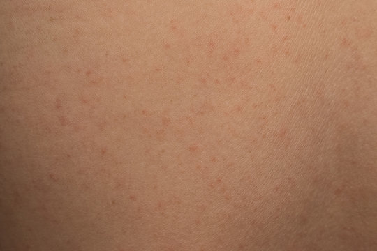 allergic rash dermatitis skin texture of patient