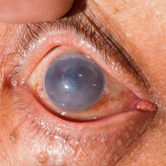 eye exam