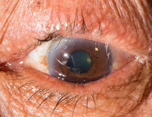 eye exam