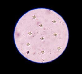 Calcium oxalate in urine analysis.