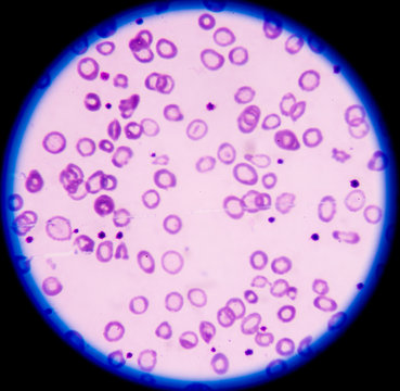  hypochromic anaemia