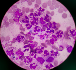 Abnormal neutrophil in pleural fluid smear.