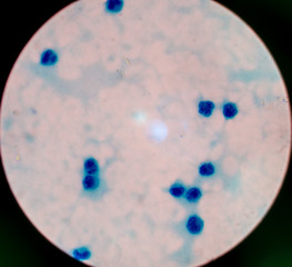 White blood cells on slide AFB, specimen pleural Fluid.