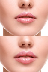 Obraz premium Lips before and after augmentation