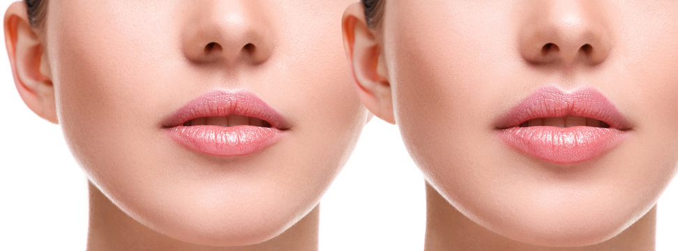 Lips  before and after augmentation