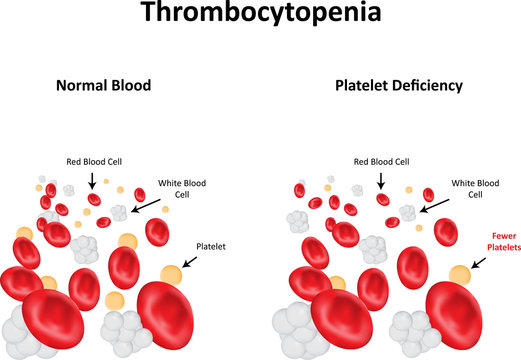 Thrombocytopenia