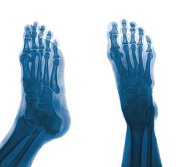 Colection x-ray of  foot