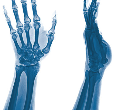 xray fracture distal radius (Colles' fracture) (wrist broken)