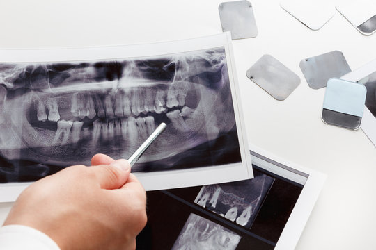 X-ray scan of humans teeth