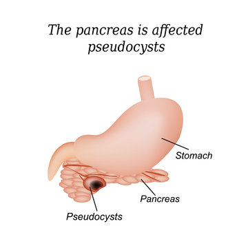 Pancreas pseudocyst affected. Vector illustration on isolated