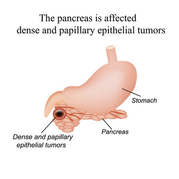 The pancreas is affected dense and papillary epithelial tumors