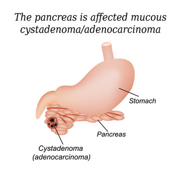 Pancreas mucous cystadenoma, adenocarcinoma. Vector illustration