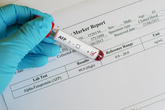 AFP (tumor Marker For Liver) Positive