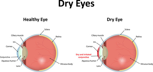 Dry Eyes Illustration