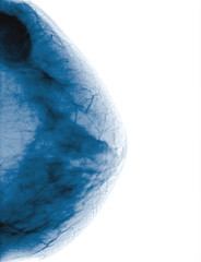 Obraz premium X-ray of Breast Cancer