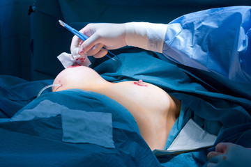 Breast augmentation - obrazy, fototapety, plakaty