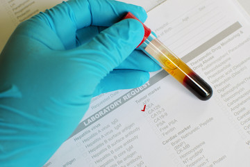 Blood sample for CEA testing